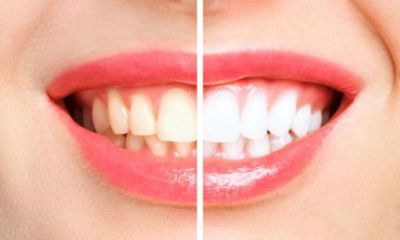 Teeth Whitening Procedures Be Risky