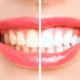 Teeth Whitening Procedures Be Risky