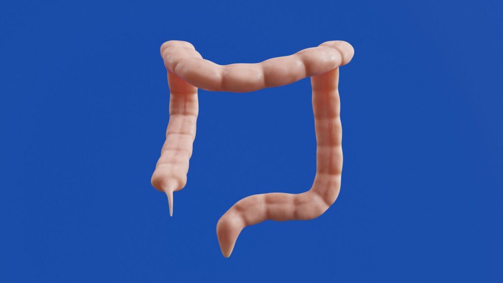The image shows a 3D model of a colon.